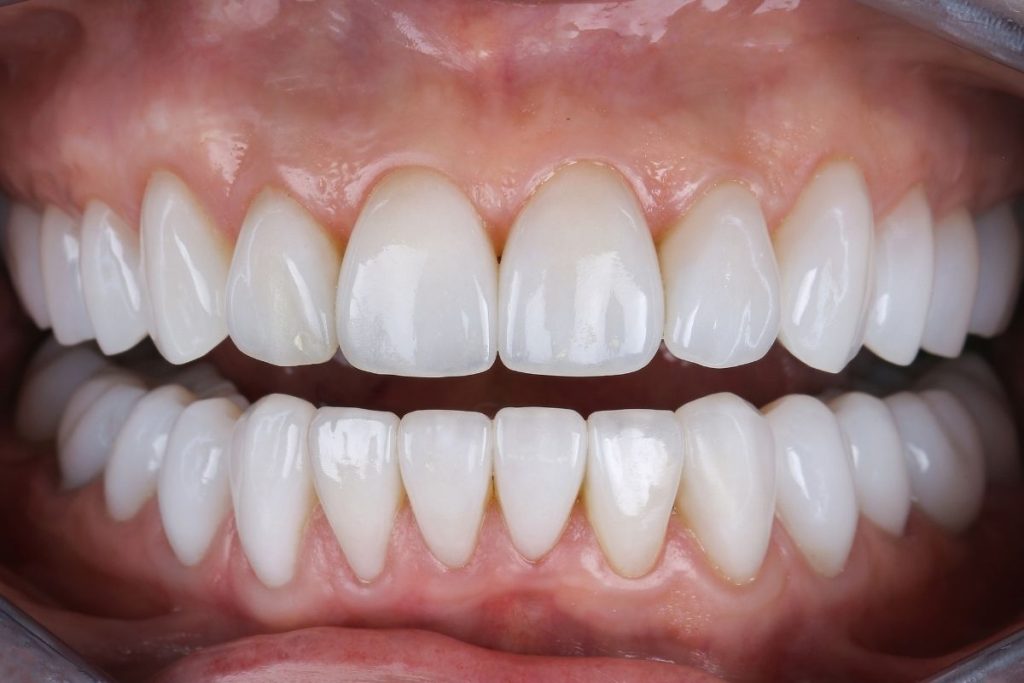 İmplant Üstü Zirkonya Diş Kaplama