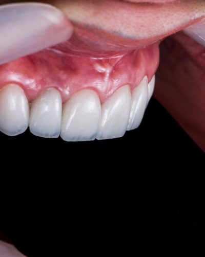 Ön Diş Zirkonya Kaplama (6)