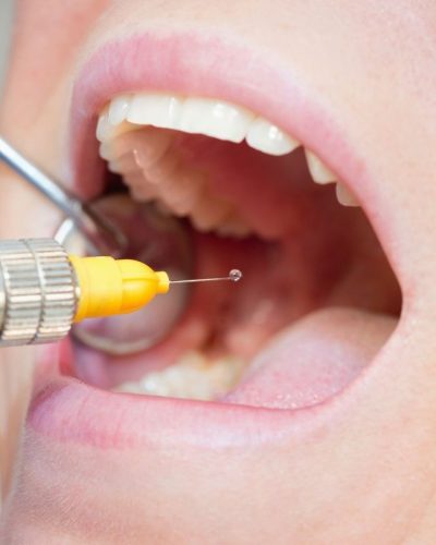 Köprü Üstü Zirkonya Diş Kaplama